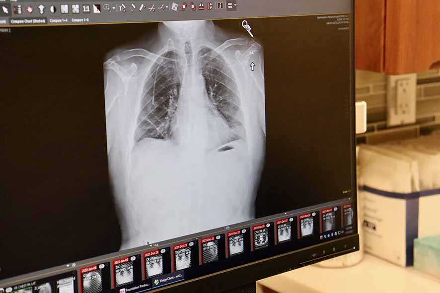 Mengenal Teknologi Endobronchial Ultrasound untuk Deteksi Kanker Paru