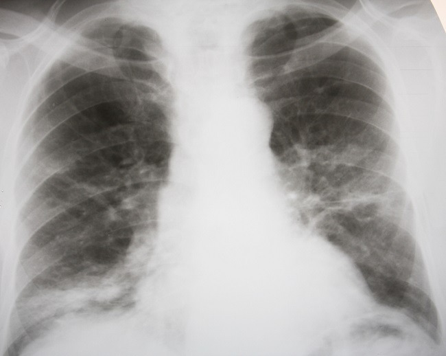 Merebak di Tangerang, Warga Perlu Memahami Bronko Pneumonia