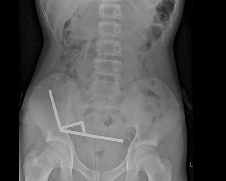 Dokter Bedah Selandia Baru Keluarkan hingga 100 Magnet  dari Usus Remaja 13 Tahun