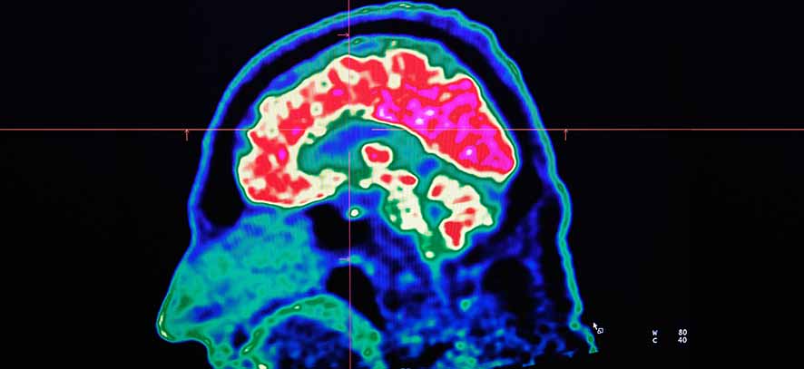 Ukuran Striatum Otak yang Lebih Besar Jadi Penanda Baru Psikopat