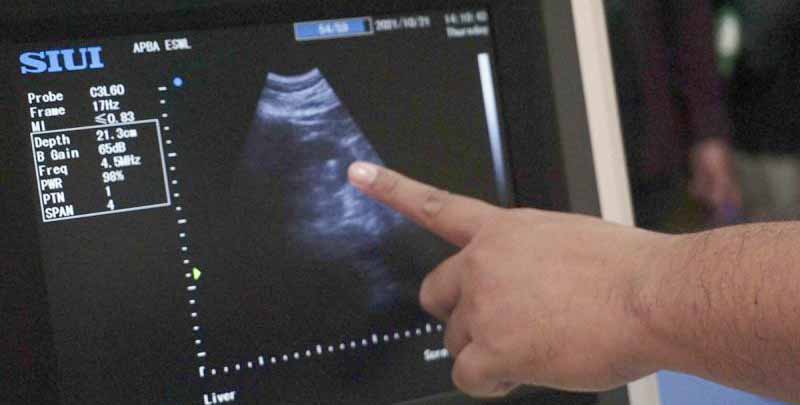 Kasus Malapraktik Selang Urine Tertinggal di Ginjal Pasien, MPDKI Vonis Bersalah Dokter SSO 