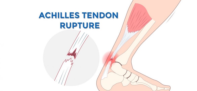 Sering Olahraga? Waspadai Cedera Tendon Achilles Berupa Nyeri di Tumit Belakang