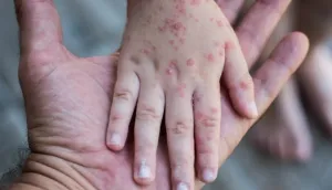 Tips Cegah Campak dari Dokter Anak RSUB