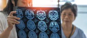 Ilmuwan Australia Ungkap Peran Protein terkait Alzheimer