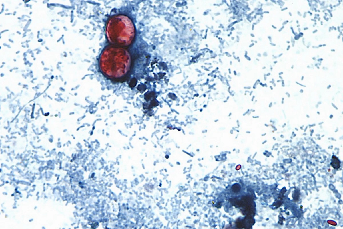 AS Konfirmasi Dua Orang Meninggal Akibat Wabah Siklosporiasis