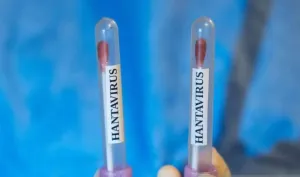 Prancis Konfirmasi Kasus Hantavirus Langka, Strain Andes Bisa Menular Antar Manusia