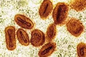 Virus Mpox Sampai ke Russia, 5 Orang Dirawat di RS Moskow