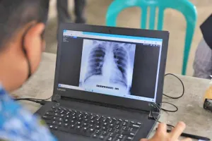 Masyarakat Diimbau Waspadai Gejala TBC dari Batuk Berkepanjangan